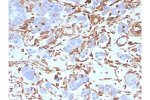 Formalin-fixed, paraffin-embedded human Colon Carcinoma stained with Vimentin Mouse Monoclonal Antibody (VIM/3736). (Vimentin anticorps  (AA 2-466))