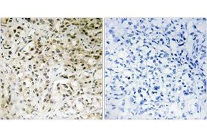 Immunohistochemistry analysis of paraffin-embedded human liver carcinoma tissue using TAF5 antibody. (TAF5 anticorps)