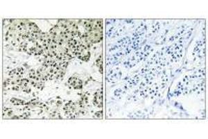 Immunohistochemistry analysis of paraffin-embedded human breast carcinoma tissue using THOC5 antibody. (THO Complex 5 anticorps)