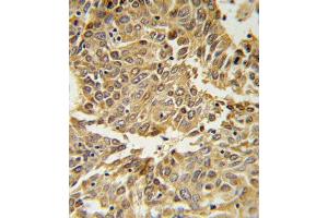 HIF1A Antibody (N-term) (ABIN650972 and ABIN2840017) IHC analysis in formalin fixed and paraffin embedded lung carcinoma followed by peroxidase conjugation of the secondary antibody and DAB staining. (HIF1A anticorps  (N-Term))