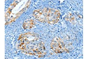 The image on the left is immunohistochemistry of paraffin-embedded Human cervical cancer tissue using ABIN7130299(MUC15 Antibody) at dilution 1/25, on the right is treated with fusion protein. (MUC15 anticorps)