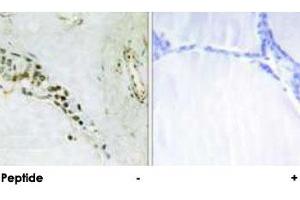 Immunohistochemical analysis of paraffin-embedded human thyroid gland tissue using CCNE2 polyclonal antibody . (Cyclin E2 anticorps)