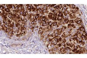 ABIN6272680 at 1/100 staining Human liver cancer tissue by IHC-P.
