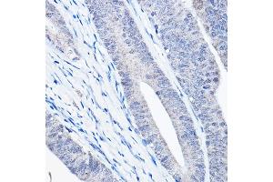 Immunohistochemistry of paraffin-embedded human colon carcinoma using Bax Rabbit mAb  at dilution of 1:25,1:50 (40x lens).