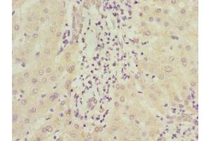 Immunohistochemistry of paraffin-embedded human liver cancer using ABIN7156542 at dilution of 1:100 (ICAM4 anticorps  (AA 20-140))