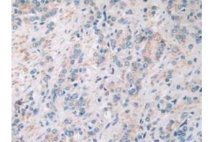 IHC-P analysis of Human Prostate Gland Cancer Tissue, with DAB staining. (SIRT4 anticorps  (AA 28-314))