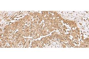Immunohistochemistry of paraffin-embedded Human esophagus cancer tissue using RCHY1 Polyclonal Antibody at dilution of 1:50(x200) (RCHY1 anticorps)