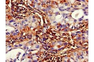 Immunohistochemistry of paraffin-embedded human lung cancer using ABIN7175344 at dilution of 1:100 (VMP1 anticorps  (AA 136-235))