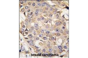 Formalin-fixed and paraffin-embedded human breast carcinoma tissue reacted with ERK1 antibody (N-term) (ABIN391719 and ABIN2841609) , which was peroxidase-conjugated to the secondary antibody, followed by DAB staining.