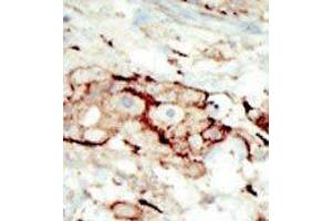 Formalin-fixed and paraffin-embedded human cancer tissue reacted with the primary antibody, which was peroxidase-conjugated to the secondary antibody, followed by AEC staining.