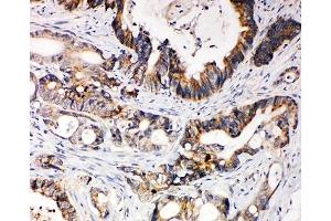 IHC-P: XIAP antibody testing of human intestinal cancer tissue (XIAP anticorps  (N-Term))