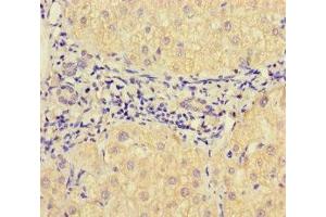 Immunohistochemistry of paraffin-embedded human liver cancer using ABIN7175471 at dilution of 1:100 (VAMP1 anticorps  (AA 1-96))