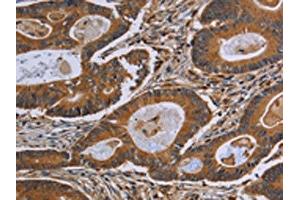 The image on the left is immunohistochemistry of paraffin-embedded Human colon cancer tissue using ABIN7190808(GJB4 Antibody) at dilution 1/40, on the right is treated with synthetic peptide. (GJB4 anticorps)