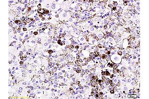 Formalin-fixed and paraffin embedded mouse melanoma labeled with Anti- MITF Polyclonal Antibody, Unconjugated (ABIN676373) at 1:200 followed by conjugation to the secondary antibody and DAB staining (MITF anticorps  (AA 351-450))