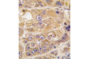 Formalin-fixed and paraffin-embedded human hepatocarcinoma tissue reacted with LDLRAP1 antibody , which was peroxidase-conjugated to the secondary antibody, followed by DAB staining. (LDLRAP1 anticorps  (C-Term))