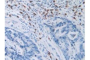 Detection of NCCT in Human Colorectal cancer Tissue using Polyclonal Antibody to Na-Cl Cotransporter (NCCT)