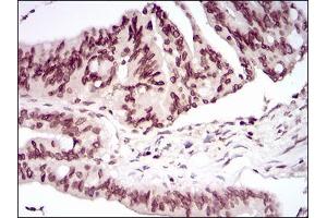 Immunohistochemical analysis of paraffin-embedded rectum cancer tissues using PER3 mouse mAb with DAB staining.
