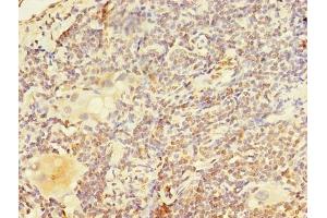 Immunohistochemistry of paraffin-embedded human lung cancer using ABIN7162495 at dilution of 1:100 (Paired Box 3 anticorps  (AA 90-184))