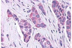 Immunohistochemistry (Formalin/PFA-fixed paraffin-embedded sections) of human breast cancer tissue with GPER polyclonal antibody . (GPER anticorps  (C-Term))
