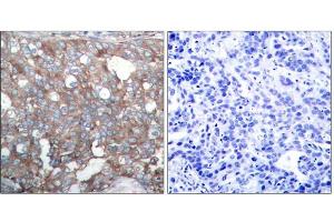 Immunohistochemical analysis of paraffin-embedded human breast carcinoma tissue, using Cortactin (Ab-421) antibody (E021263). (Cortactin anticorps)