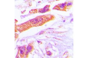 Immunohistochemical analysis of PSMD6 staining in human lung cancer formalin fixed paraffin embedded tissue section.