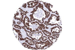 Strong EPCAM staining in an adenocarcinoma of the lung