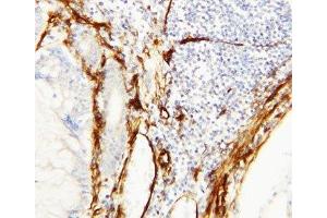 IHC-P: Caveolin-1 antibody testing of human breast cancer tissue (Caveolin-1 anticorps  (C-Term))