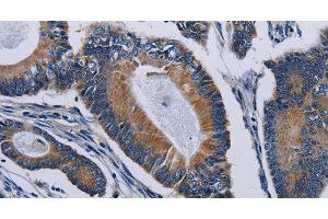Immunohistochemistry of paraffin-embedded Human colon cancer tissue using PCDHAC2 Polyclonal Antibody at dilution 1:50 (PCDHAC2 anticorps)