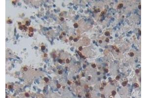 Detection of PP13 in Human Lung cancer Tissue using Polyclonal Antibody to Placental Protein 13 (PP13) (LGALS13 anticorps  (AA 1-139))