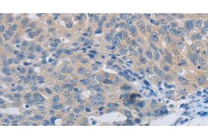 Immunohistochemistry of paraffin-embedded Human ovarian cancer using MMP8 Polyclonal Antibody at dilution of 1:45 (MMP8 anticorps)