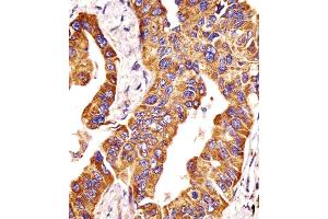 Antibody staining MMP14 in human lung adenocarcinoma tissue sections by Immunohistochemistry (IHC-P - paraformaldehyde-fixed, paraffin-embedded sections). (MMP14 anticorps  (N-Term))