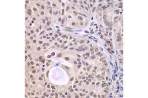 Immunohistochemistry of paraffin-embedded human oophoroma using DDX5 antibody.