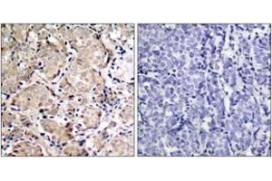 Immunohistochemistry analysis of paraffin-embedded human breast carcinoma, using FKHR (Phospho-Ser319) Antibody. (FOXO1 anticorps  (pSer319))