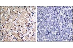 Immunohistochemistry analysis of paraffin-embedded human breast carcinoma, using FKHR (Phospho-Ser319) Antibody. (FOXO1 anticorps  (pSer319))