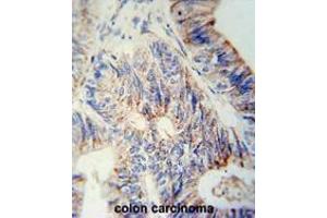 B3GNT6 Antibody (Center) immunohistochemistry analysis in formalin fixed and paraffin embedded human colon carcinoma followed by peroxidase conjugation of the secondary antibody and DAB staining. (B3GNT6 anticorps  (Middle Region))