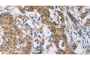 Immunohistochemistry of paraffin-embedded Human gastric cancer tissue using CERK Polyclonal Antibody at dilution 1:30 (CERK anticorps)