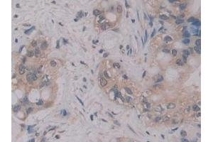 Detection of MPG1 in Human Liver cancer Tissue using Polyclonal Antibody to Macrophage Expressed Gene 1 Protein (MPG1) (MPEG1 anticorps  (AA 313-580))