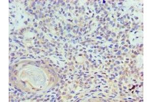 Immunohistochemistry of paraffin-embedded human breast cancer using ABIN7150350 at dilution of 1:100 (TOPBP1 anticorps  (AA 1253-1522))