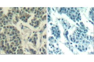 Immunohistochemical analysis of paraffin- embedded human breast carcinoma tissue using Her3/ErbB3 (phospho-Tyr1328) Antibody (E011510) . (ERBB3 anticorps  (pTyr1328))