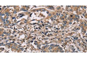 Immunohistochemistry of paraffin-embedded Human liver cancer using HSD17B12 Polyclonal Antibody at dilution of 1:30 (HSD17B12 anticorps)