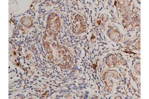 ABIN6269175 at 1/200 staining human breast cancer tissue sections by IHC-P. (FLT1 anticorps)