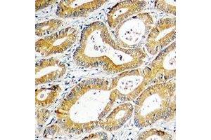 Immunohistochemical analysis of SGK1 staining in human colon cancer formalin fixed paraffin embedded tissue section. (SGK1 anticorps  (C-Term))