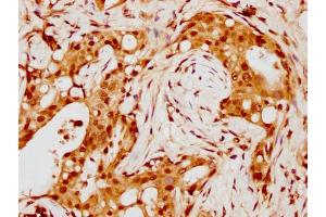 IHC image of nohHU diluted at 1:8 and staining in paraffin-embedded human breast cancer performed on a Leica BondTM system.