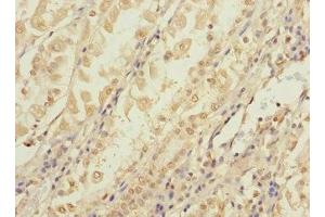 Immunohistochemistry of paraffin-embedded human gastric cancer using ABIN7148092 at dilution of 1:100 (CCDC15 anticorps  (AA 1-245))