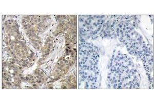 Immunohistochemical analysis of paraffin-embedded human breast carcinoma tissue, using β-Catenin (Ab-37) antibody (E021212). (beta Catenin anticorps)