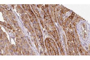 ABIN6267107 at 1/100 staining Human thyroid cancer tissue by IHC-P.