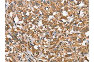 The image on the left is immunohistochemistry of paraffin-embedded Human thyroid cancer tissue using ABIN7190368(CSMD1 Antibody) at dilution 1/40, on the right is treated with synthetic peptide. (CSMD1 anticorps)