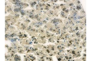 ABIN6260356 and ABIN6278190 at 1/100 staining human melanoma by IHC-P. (BORA anticorps  (C-Term))