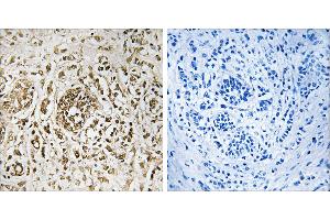 Peptide - +Immunohistochemistry analysis of paraffin-embedded human breast carcinoma tissue, using CIB2 antibody. (CIB2 anticorps  (Internal Region))