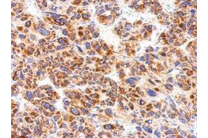 IHC-P Image CXCR1 antibody [C2C3], C-term detects IL8RA protein at cytosol on human hepatoma by immunohistochemical analysis. (CXCR1 anticorps  (C-Term))